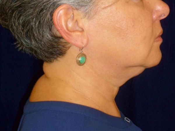 nonsurgical skin tightening for face patient