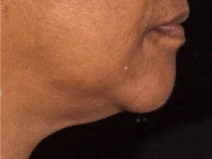 nonsurgical skin tightening for face patient