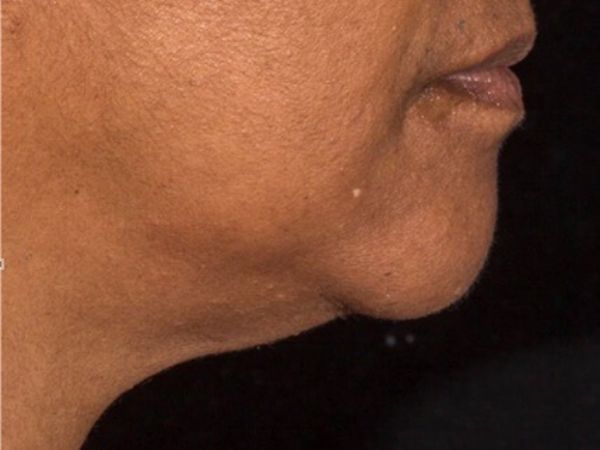 nonsurgical skin tightening for face patient