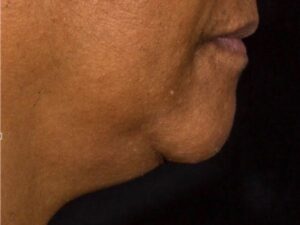 nonsurgical skin tightening for face patient