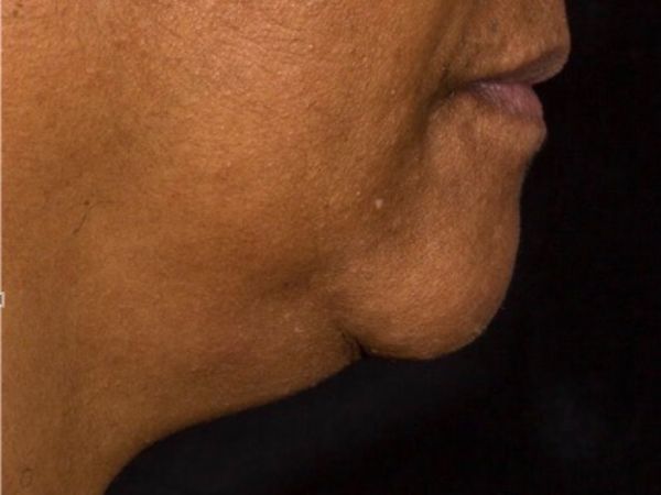 nonsurgical skin tightening for face patient
