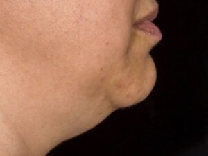 nonsurgical skin tightening for face patient