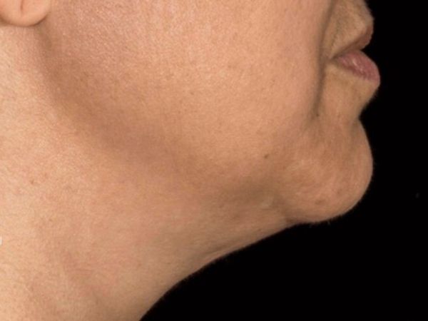 nonsurgical skin tightening for face patient