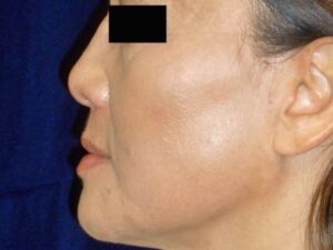 nonsurgical skin tightening for face patient