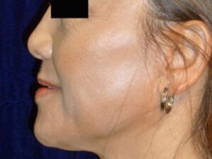 nonsurgical skin tightening for face patient