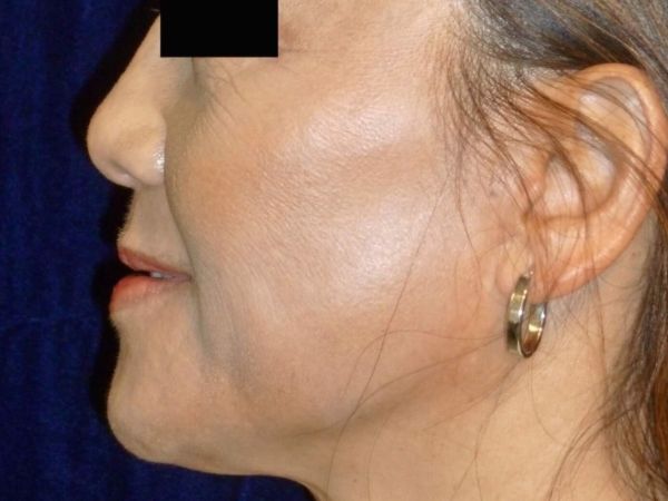 nonsurgical skin tightening for face patient