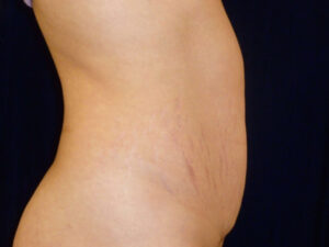 tummy tuck patient