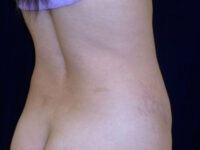 tummy tuck patient