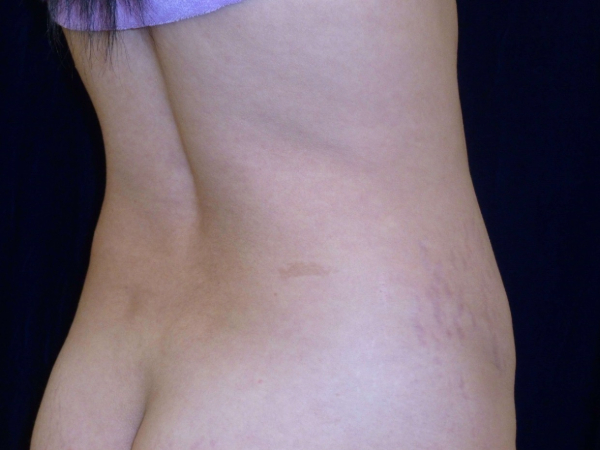 tummy tuck patient