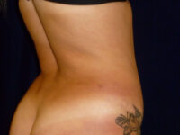 tummy tuck patient