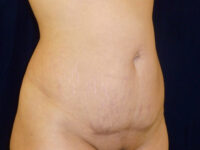 tummy tuck patient