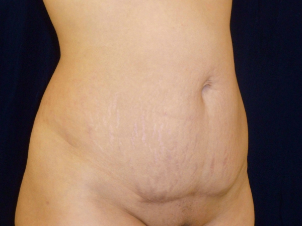 tummy tuck patient