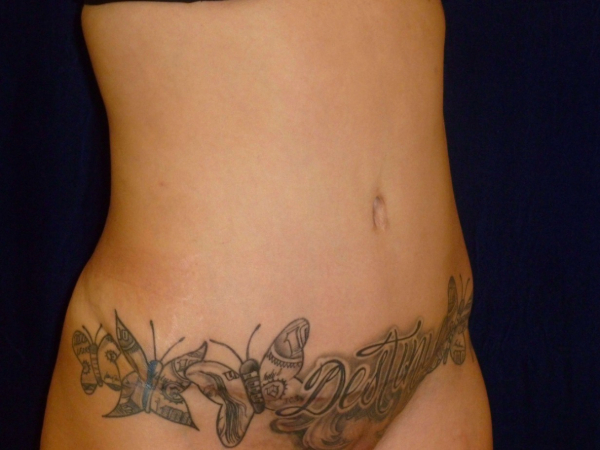 tummy tuck patient
