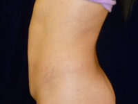 tummy tuck patient
