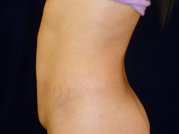 tummy tuck patient