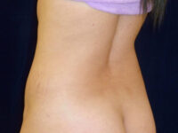 tummy tuck patient