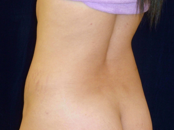 tummy tuck patient