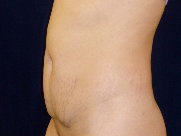 tummy tuck patient
