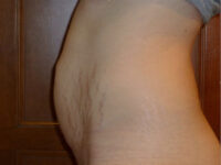 tummy tuck patient