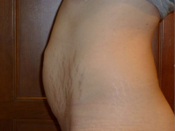 tummy tuck patient