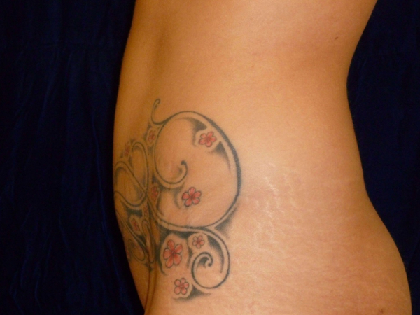 tummy tuck patient