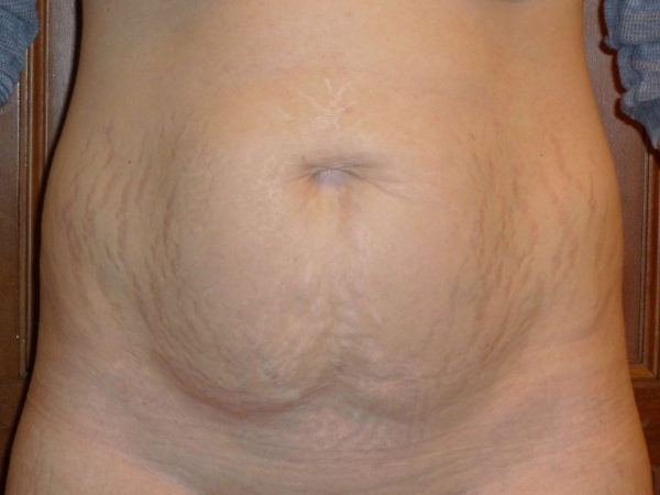 tummy tuck patient