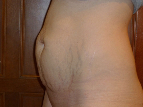 tummy tuck patient