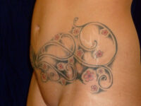 tummy tuck patient