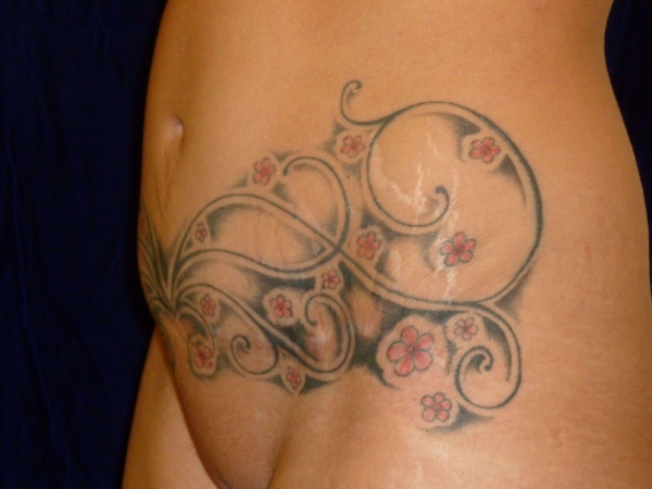 tummy tuck patient