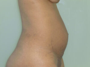 tummy tuck patient