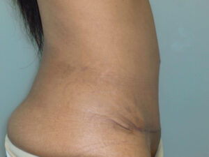 tummy tuck patient