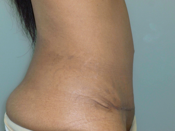 tummy tuck patient