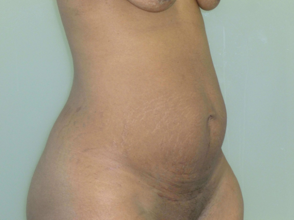 tummy tuck patient