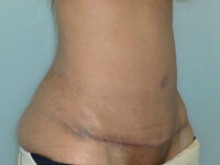 tummy tuck patient