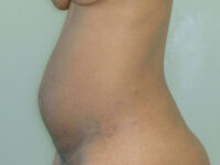 tummy tuck patient
