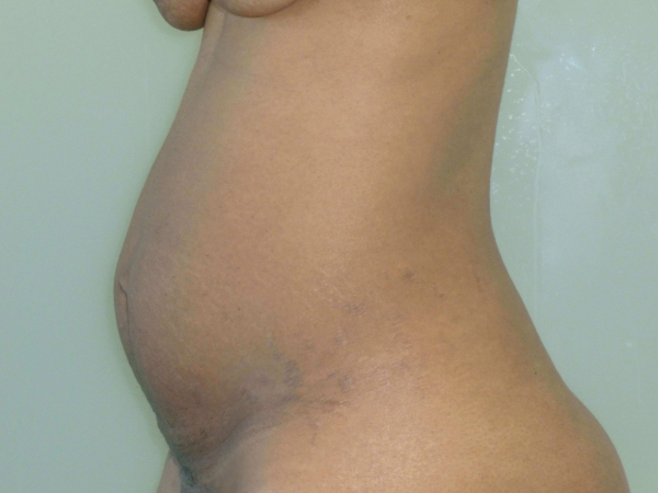 tummy tuck patient