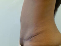 tummy tuck patient