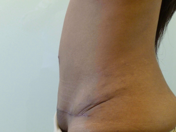 tummy tuck patient