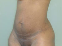 tummy tuck patient