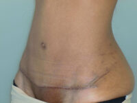 tummy tuck patient