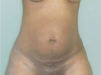 tummy tuck patient