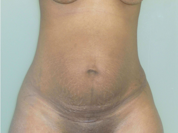 tummy tuck patient