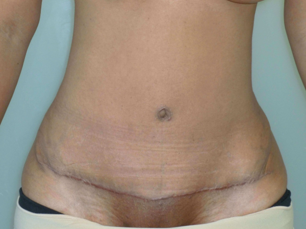 tummy tuck patient