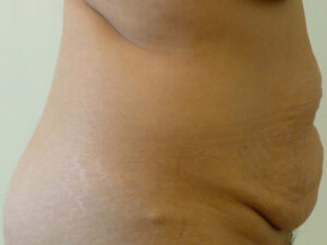 tummy tuck patient