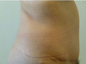 tummy tuck patient