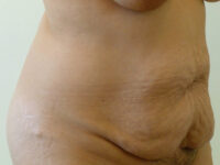 tummy tuck patient