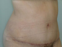 tummy tuck patient