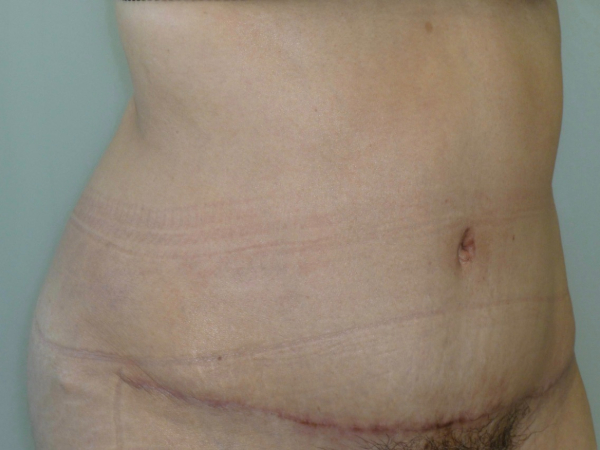 tummy tuck patient