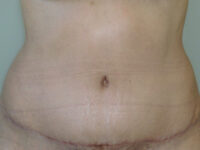 tummy tuck patient