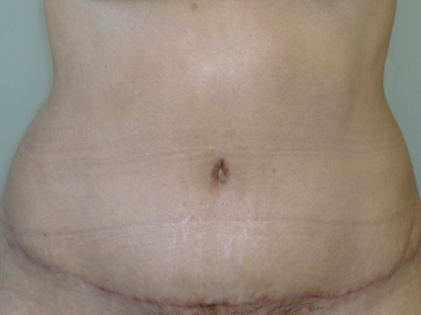 tummy tuck patient